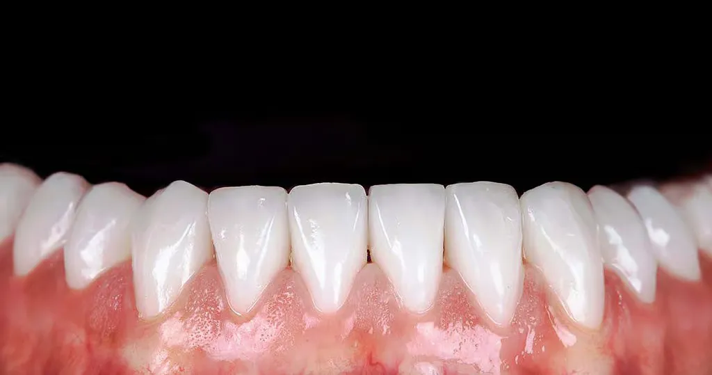 Dental veneers treatment in Albania at ICE ALB Smiles