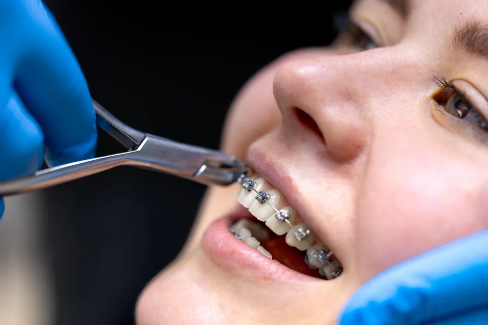 Orthodontic treatment and teeth straightening in Albania at ICE ALB Smiles