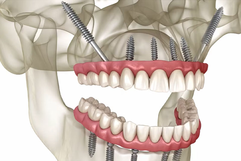 severe bone loss dental implants- zigomatic implants
